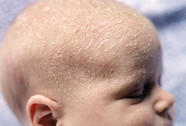 Excess Oil Causes Cradle Cap