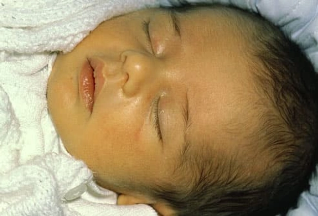 Yellow Skin Can Mean Jaundice Yellow Skin Can Mean Jaundice