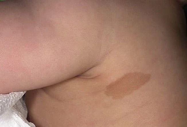 Birthmarks Birthmarks