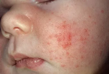Your baby may develop an acne-like rash. But the good news is, most go away on their own with time. (Photo credit: Interactive Medical Media LLC)
