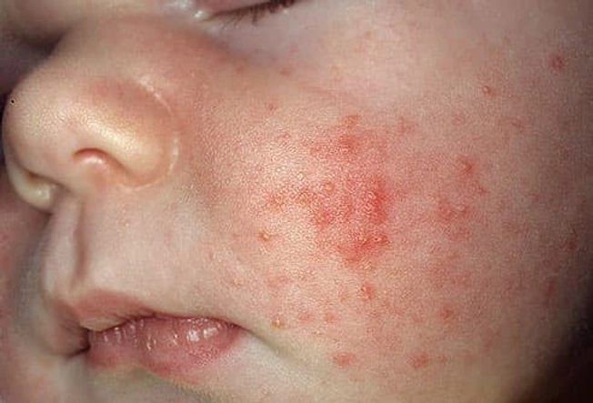 What to Do With Pimples & Whiteheads What to Do With Pimples & Whiteheads