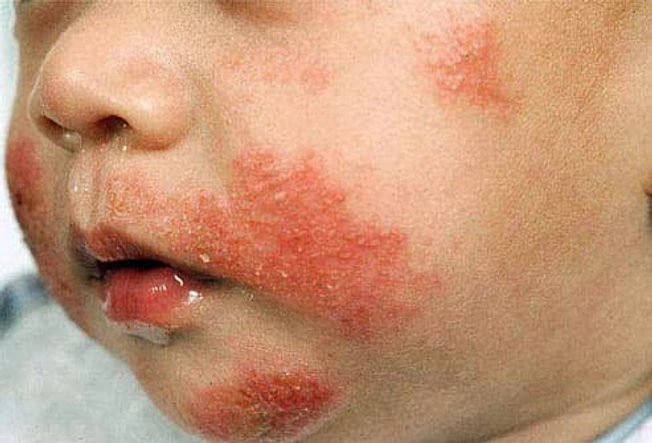 Eczema Eczema
