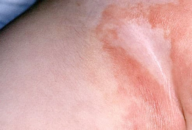Avoid Diaper Rash Avoid Diaper Rash