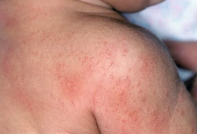 Prickly Heat Causes Irritated Skin Prickly Heat Causes Irritated Skin