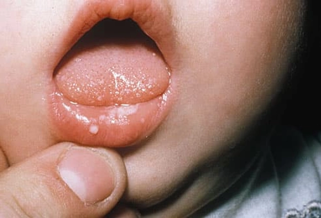 Baby Yeast Infections Baby Yeast Infections