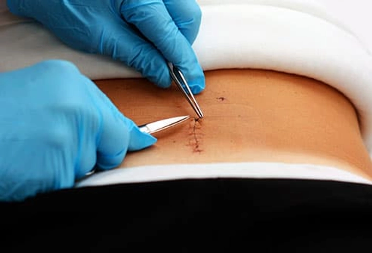 At Home: Wound Care At Home: Wound Care