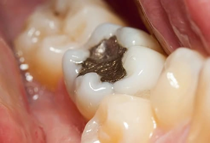 Cracked Teeth and Fillings Cracked Teeth and Fillings