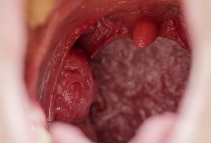 Tonsil Stones Tonsil Stones