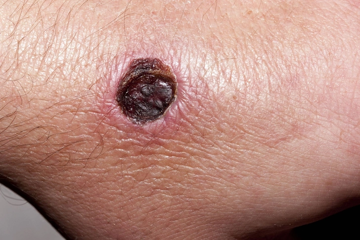 Black Widow Spider Bites