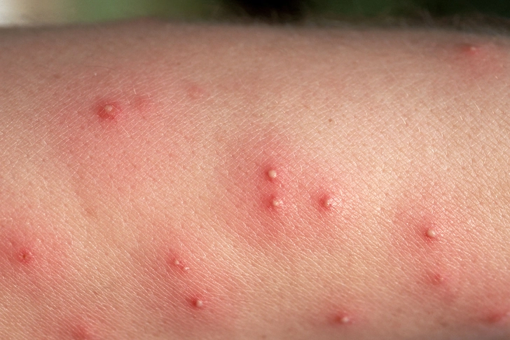 Fire Ant Stings