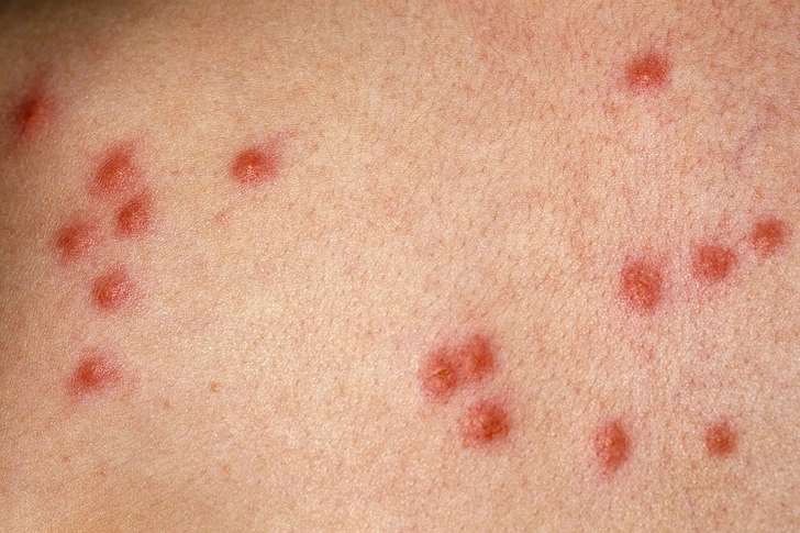 Flea Bites