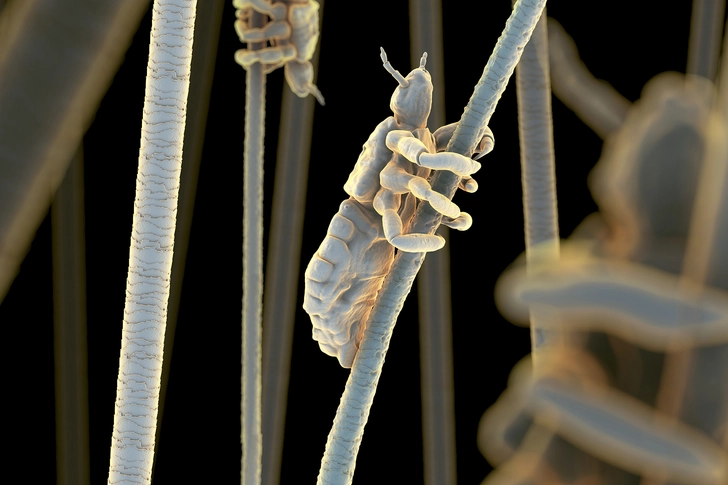 Head Lice: Itchy!