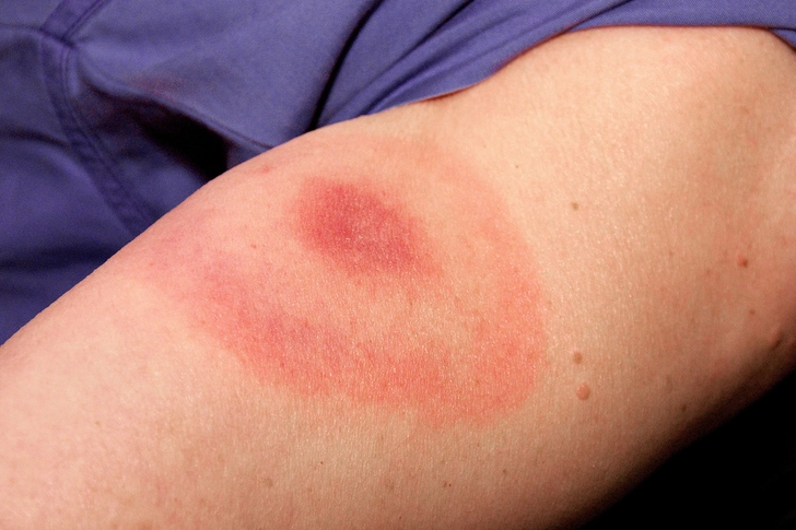 Lyme Disease