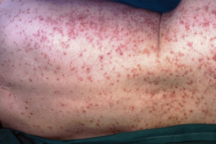 Treating Scabies