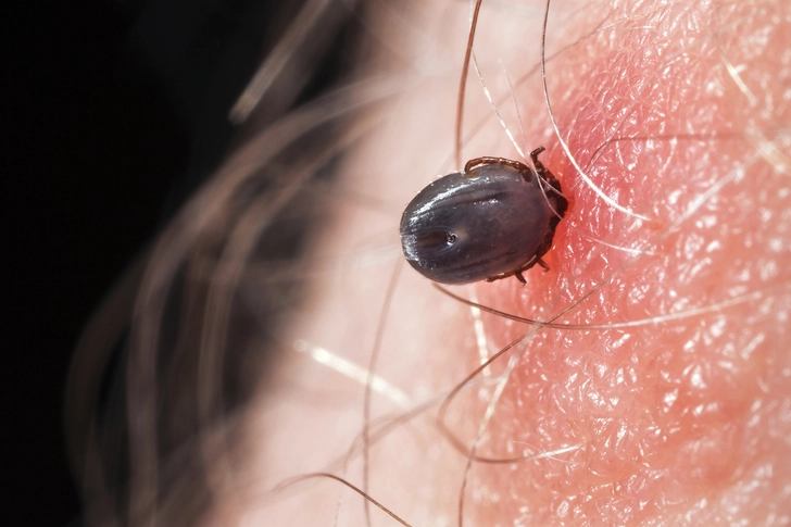 Tick Bites
