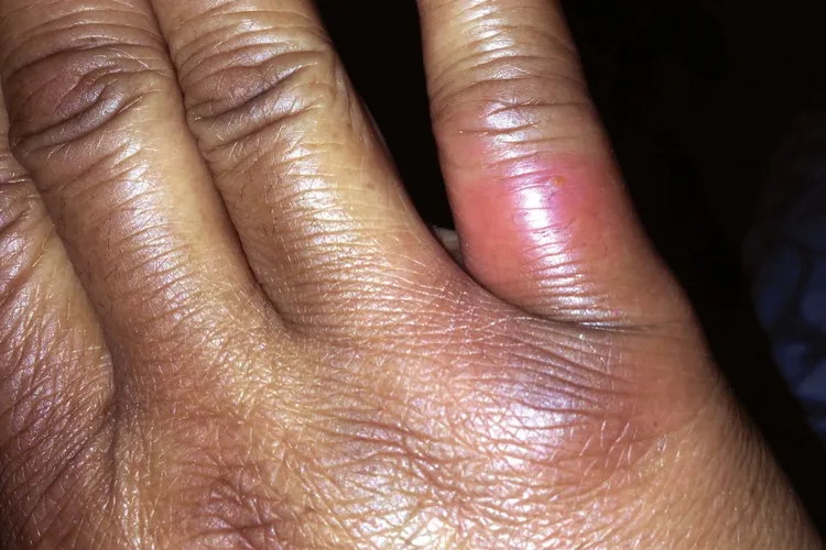 photo of brown recluse spider bite