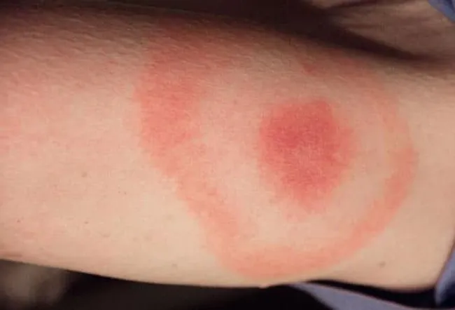 The rashes that may come with Lyme disease can vary in how they look. Photo courtesy of CDC.