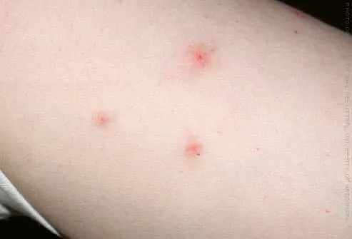 Bedbug bites on person's arm