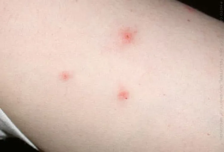 Bedbugs tend to leave groups of bites in a straight row or zigzag pattern. Photo courtesy of Phil Pellitteri, University of Wisconsin