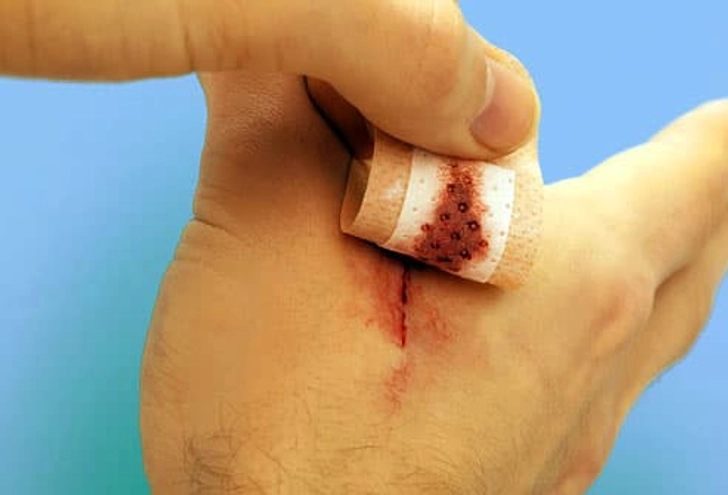 Cuts on Hands or Feet: Keep Them Clean Cuts on Hands or Feet: Keep Them Clean