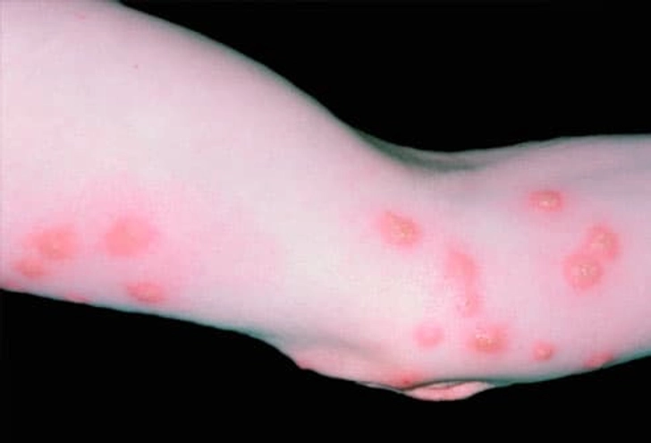 Treating Bites Treating Bites