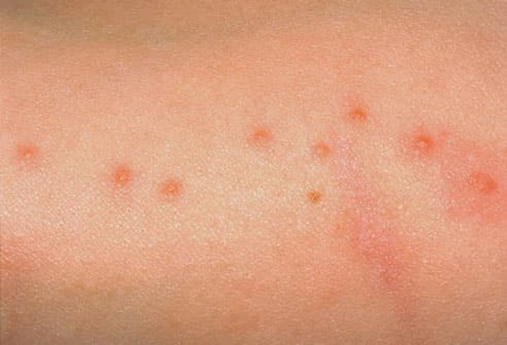 Signs and Symptoms of Bedbug Bites Signs and Symptoms of Bedbug Bites