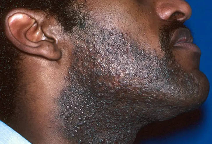 Ingrown Hairs and Razor Burn Ingrown Hairs and Razor Burn