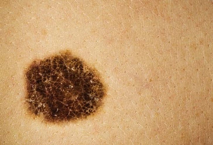 Skin Cancer