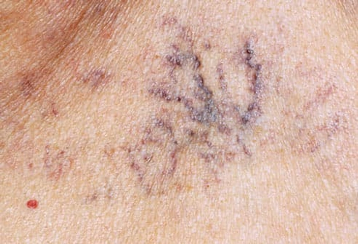 Angioma