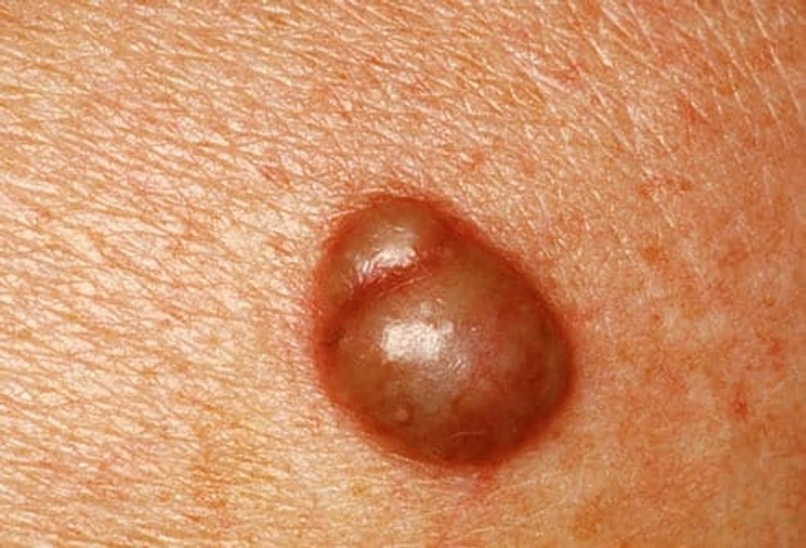 Cyst