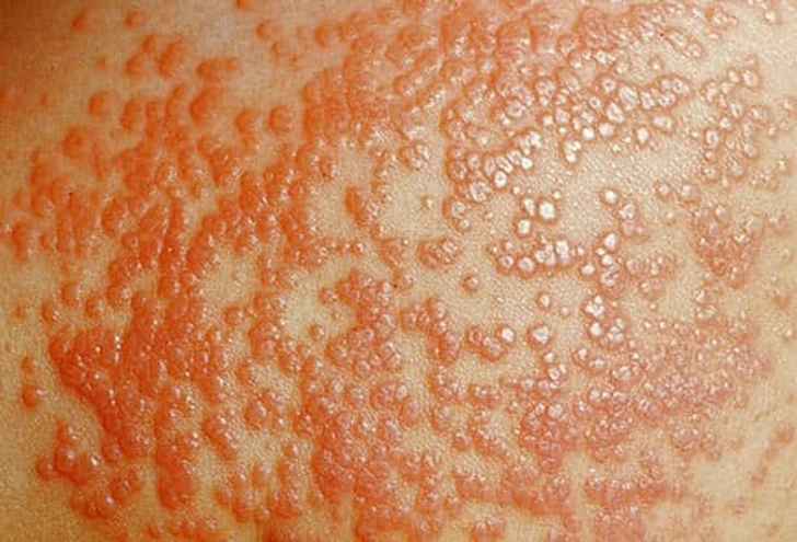 Genital Warts Genital Warts