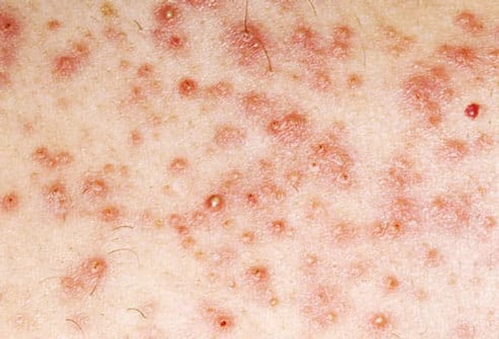 Folliculitis