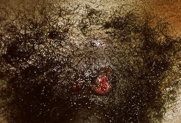 Syphilis