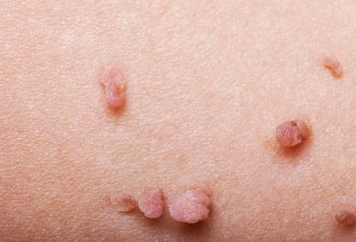 Skin Tag Skin Tag
