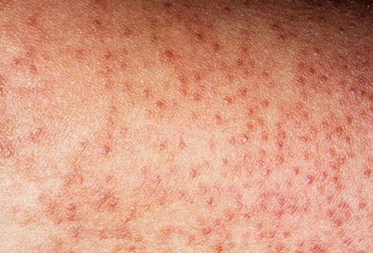 Keratosis Pilaris Keratosis Pilaris