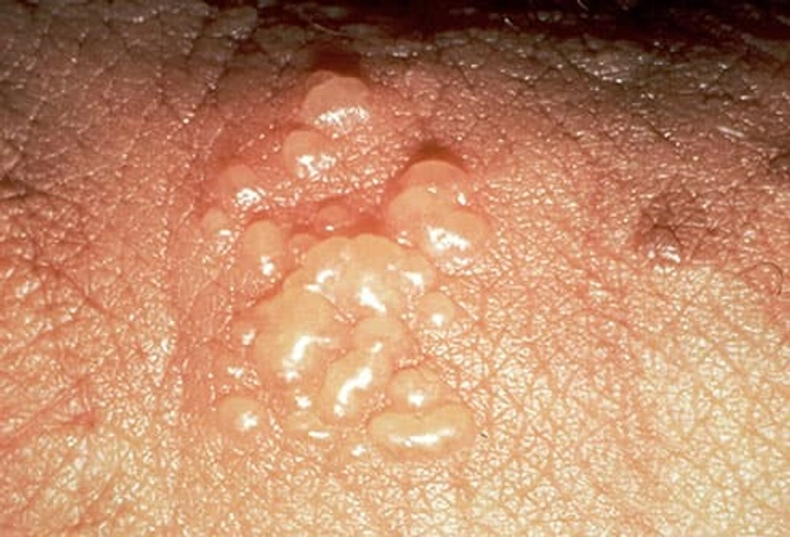 Genital Herpes