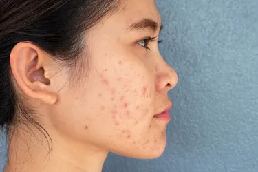 Many at-home or in-office treatments can help clear up acne scars. A dermatologist can explain what's most likely to work for your skin. (Photo Credit: iStock/Getty Images) 