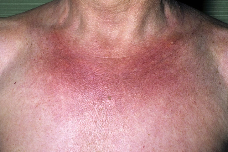 Morphea