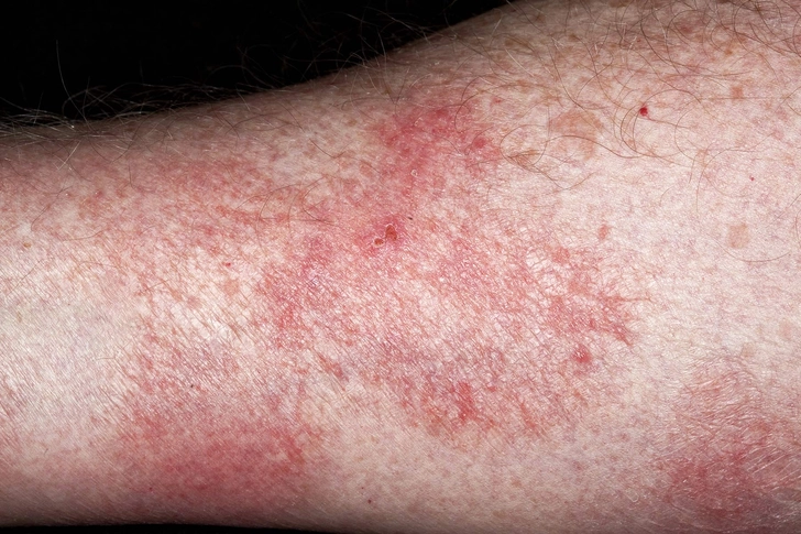 Mycosis Fungoides