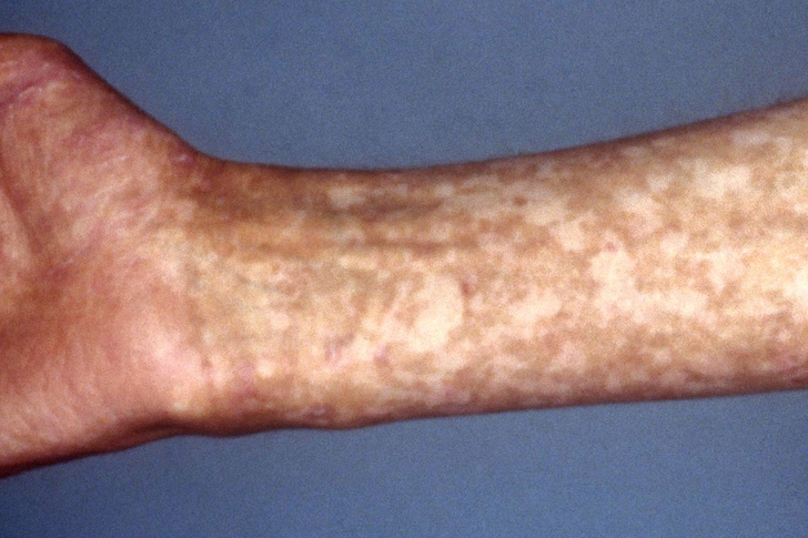 Cutaneous Graft-Versus-Host Disease (cGVHD)