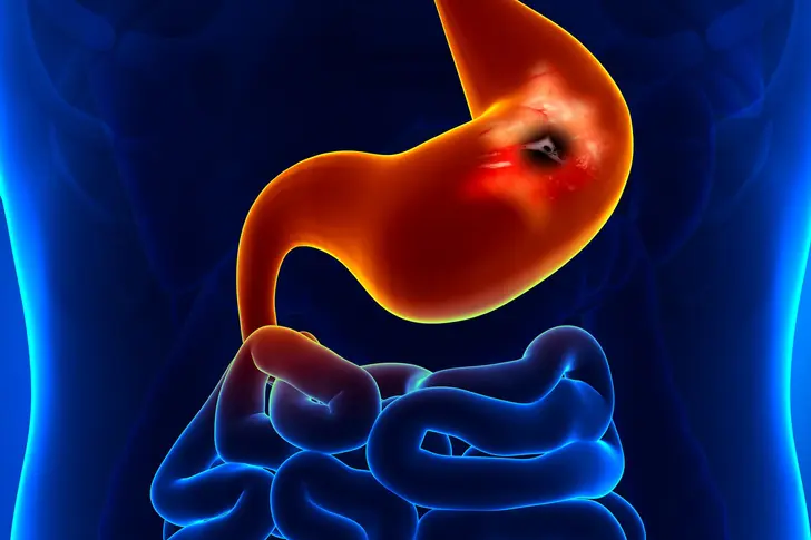 What Causes Ulcers?