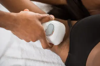 photo of laser hair removal