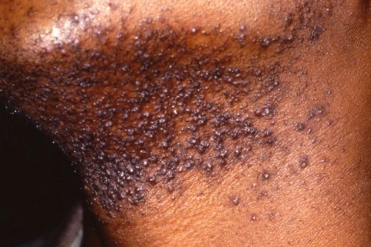 Shaving Bumps