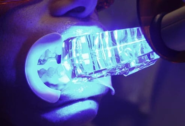 Whitening by a Pro Whitening by a Pro