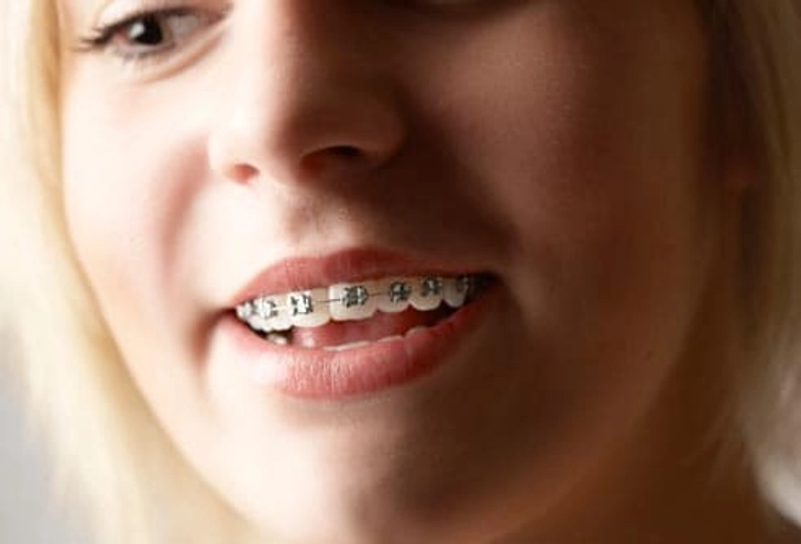 Braces for Beauty