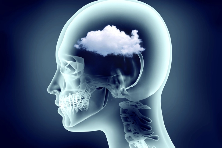 Brain Fog