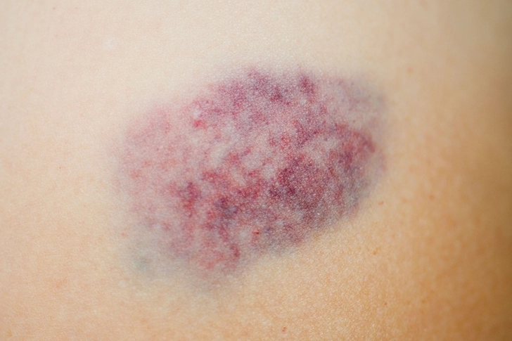 Thin Skin and Bruises