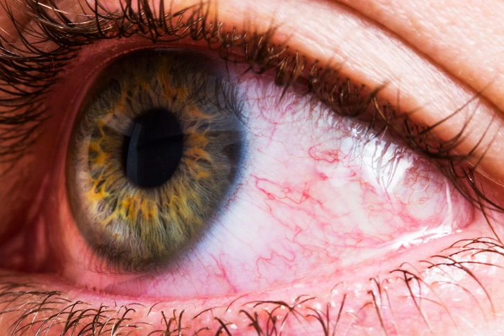 Eye Irritation