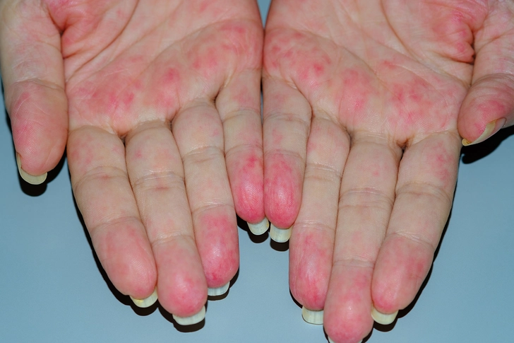 Rash