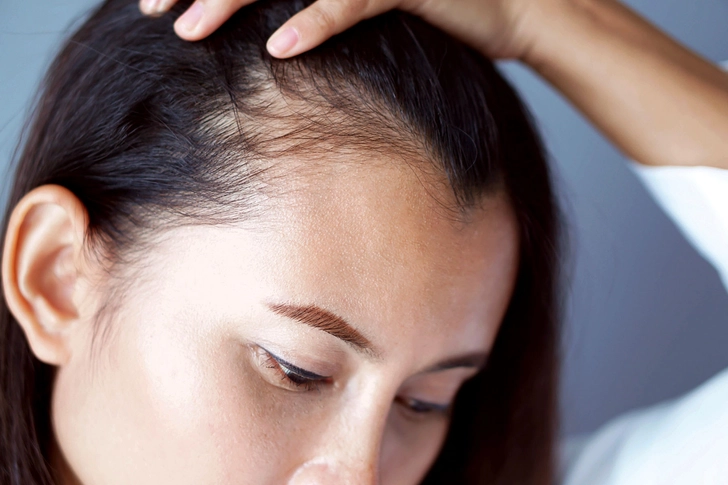 Hair Loss